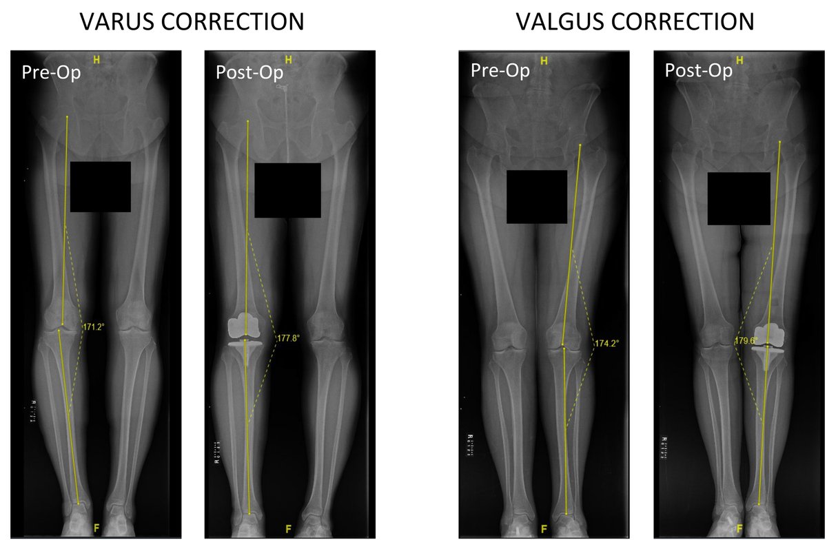 StephenJIncavo's tweet photo. Our latest research, Impact of Valgus vs Varus Mechanical Axis Correction during Primary Total Knee Arthroplasty on Postoperative Periarticular Bone Mineral Density, appears in the Journal of Arthroplasty - https://t.co/TN2AJDPIkO #totalkneereplacement https://t.co/MNtYjsKVsX