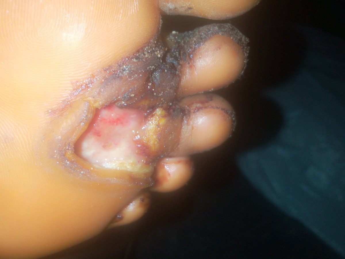 kingpois's tweet photo. @Mazigburugburu1 nde wo sir, biko sir I need ur help I need to treat my diabetic foot ulcer almost 2 yrs the odour is now a concern in my office https://t.co/UK6AwTj2Sg