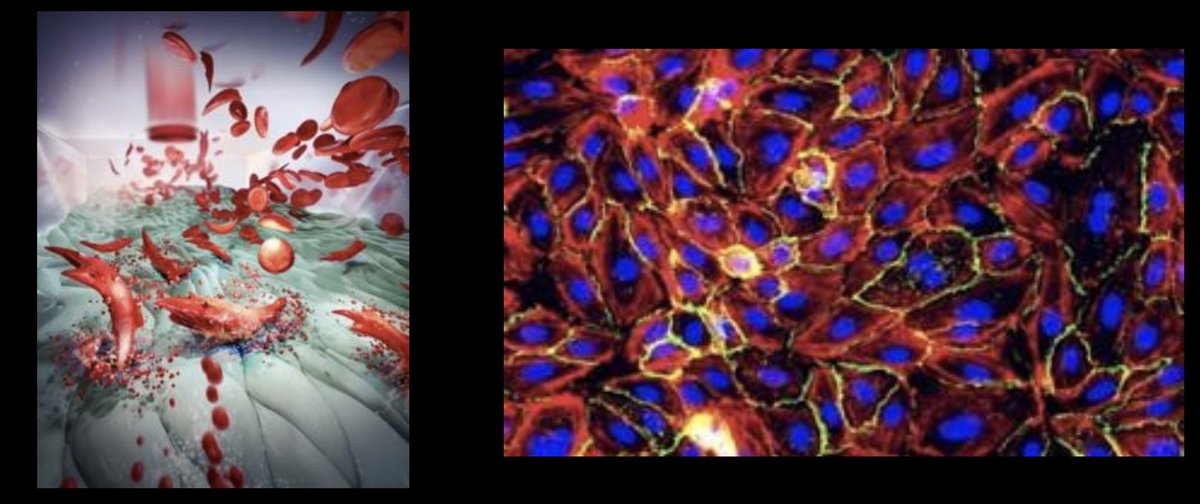 Umut A. Gurkan (@uagurkan) on Twitter photo Congratulations to <a href="/ErdemKucukal/">Erdem Kucukal</a> and #BioChipLabs for STTR award from <a href="/NSF/">U.S. National Science Foundation</a> <a href="/NSFSBIR/">uchiha mrx</a> “Standardized and reproducible culture and activation of endothelial cells in microfluidic devices for drug screening applications” <a href="/cwru/">Case Western Reserve</a> <a href="/CaseEngineer/">CWRU Engineering</a> <a href="/CleveHealthTech/">Health Tech Corridor</a> -> nsf.gov/awardsearch/sh… Congratulations to <a href="/ErdemKucukal/">Erdem Kucukal</a> and #BioChipLabs for STTR award from <a href="/NSF/">U.S. National Science Foundation</a> <a href="/NSFSBIR/">uchiha mrx</a> “Standardized and reproducible culture and activation of endothelial cells in microfluidic devices for drug screening applications” <a href="/cwru/">Case Western Reserve</a> <a href="/CaseEngineer/">CWRU Engineering</a> <a href="/CleveHealthTech/">Health Tech Corridor</a> -> nsf.gov/awardsearch/sh…