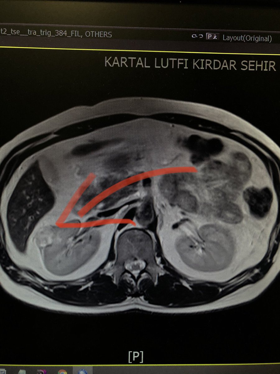 drutkucan's tweet photo. 👉🏻Böbrek kanserleri erken evrelerde semptom vermez.Genellikle rutin kontroller sırasında ultrasonografide saptanır
 👉🏻 40 yaşında böbrek kanseri saptadığımız hastamızın ameliyatını laparoskopik yöntemle ve sağlıklı böbrek dokusunu koruyacak şekilde yaptık. https://t.co/sA4BShb7RI