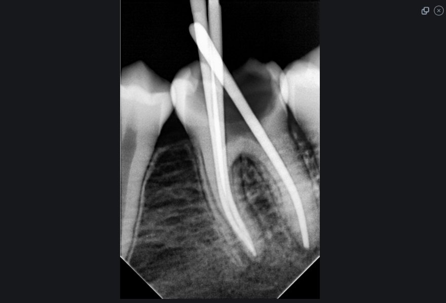 dent_mido96's tweet photo. Single visit Endo treatment of tooth nu. 36 ❤️ https://t.co/nHgk1o2UAR
