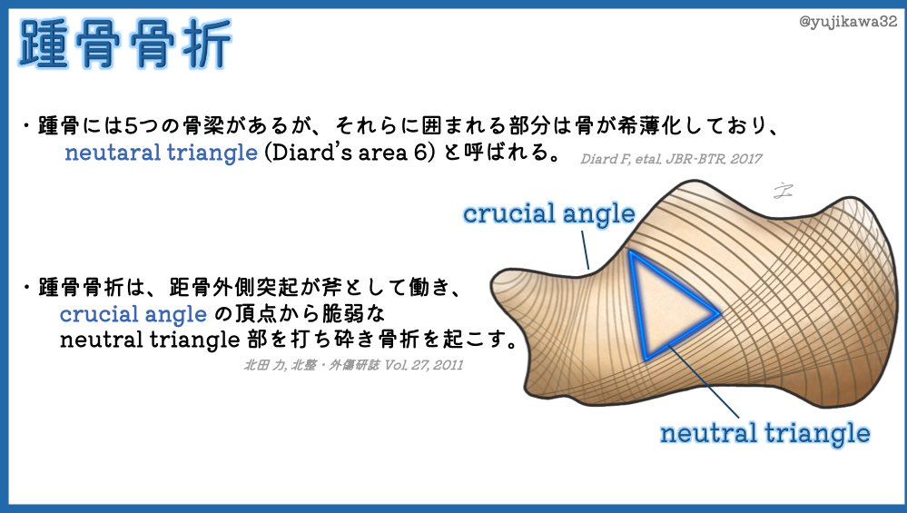 ユジカワ 整形dr イラストレーター 踵骨骨折が いつも似たような折れ方をする理由の一つはこれ シンプルなtongueタイプだと 合併症が少ないピンニングで済む可能性が高い イラスト日記 踵骨骨折 T Co Nkojgova9m Twitter ユジカワ 整形dr イラストレーター 踵骨骨折が いつも似たような折れ方をする理由の一つはこれ シンプルなtongueタイプだと 合併症が少ないピンニングで済む可能性が高い イラスト日記 踵骨骨折 T Co Nkojgova9m Twitter