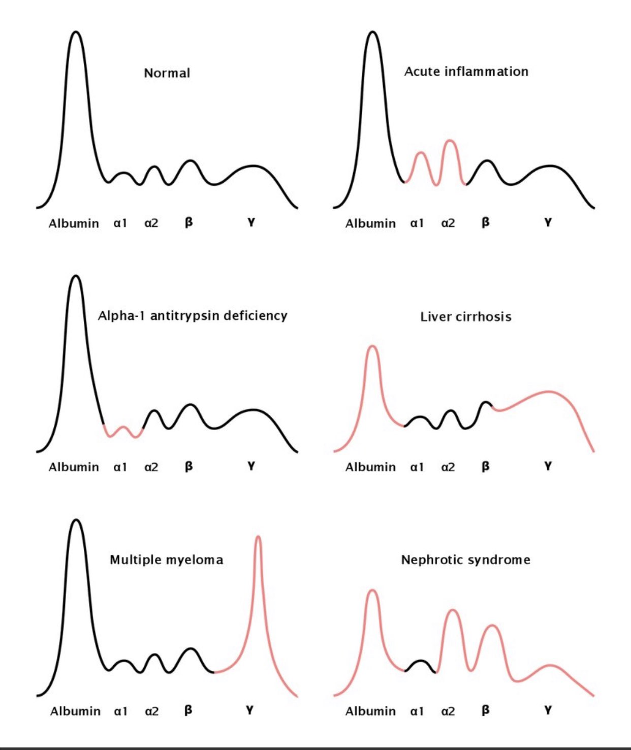 AlOla A Abdallah MD on Twitter "Serum protein electrophoresis with