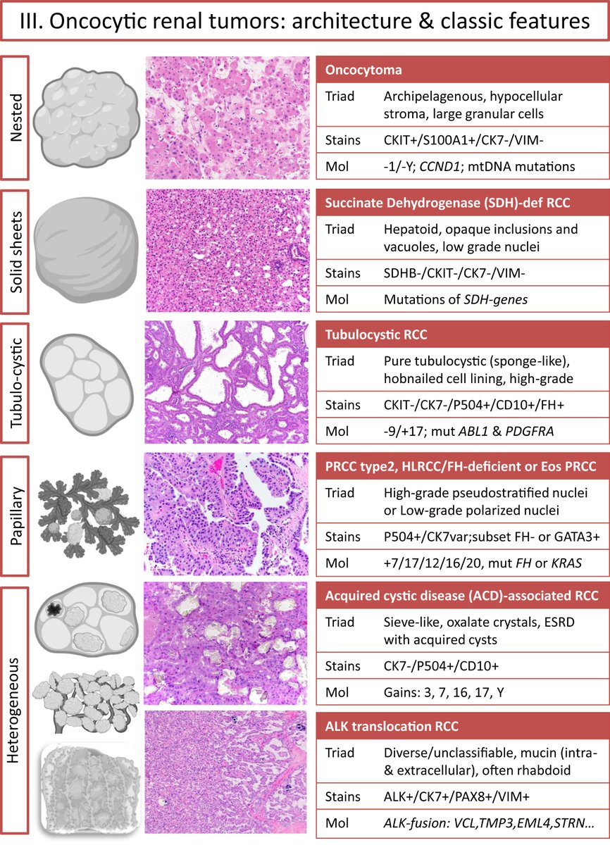 thejourneymate's tweet photo. Renal Cell Tumors: Molecular Findings Reshaping Clinico-Pathological Practice

Molecular testing may be needed for definitive diagnosis and treatment of tumors that have ambiguous features, poorly differentiated, or with underlying hereditary syndrome. 
https://t.co/EnDzpYA46B https://t.co/9B7xKhOLZ9