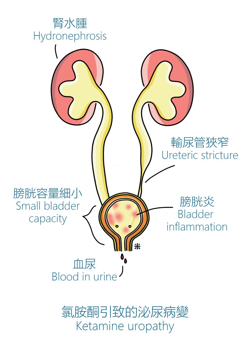[#CUHKUrology] Frequent urination is the most common symptom in ketamine abusers. Quitting ketamine is expected to gradually improve the related symptoms. Self-assessment of overactive bladder symptoms: bit.ly/3voTG8D

Illustration by <a href="/bowlful/">Brian Dell</a>.of.rice