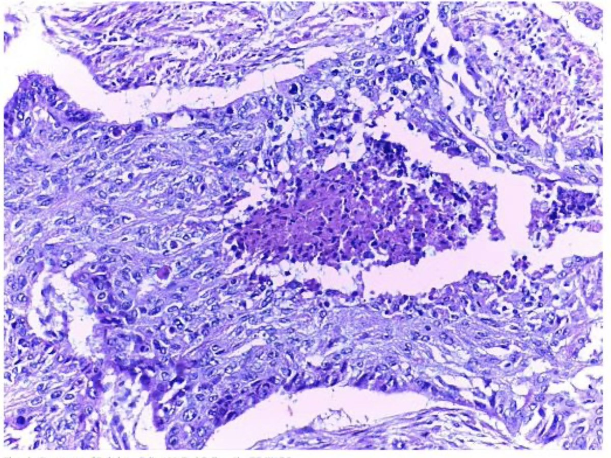 DocInCrocs's tweet photo. "Increased mitotic figures (look for fuzzy caterpillars).." Where?! This is turning into a sick game of hide and go seek-the-squamous-cell-carcinoma. #PTHrP https://t.co/rhVixV8kmE