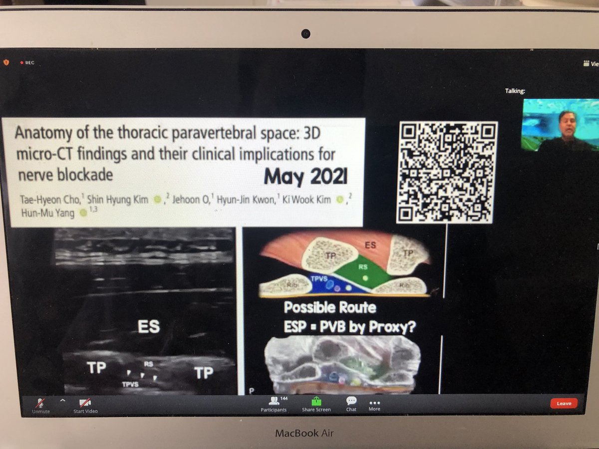 Ezequiel Ferrara (@ezeferraramd) on Twitter photo Great lecture of <a href="/amit_pawa/">Dr Amit Pawa💉🎙️</a> regarding updates un ESP. Promising new info of what we’ll be learning during this 2021. #ISURA2021 Great lecture of <a href="/amit_pawa/">Dr Amit Pawa💉🎙️</a> regarding updates un ESP. Promising new info of what we’ll be learning during this 2021. #ISURA2021