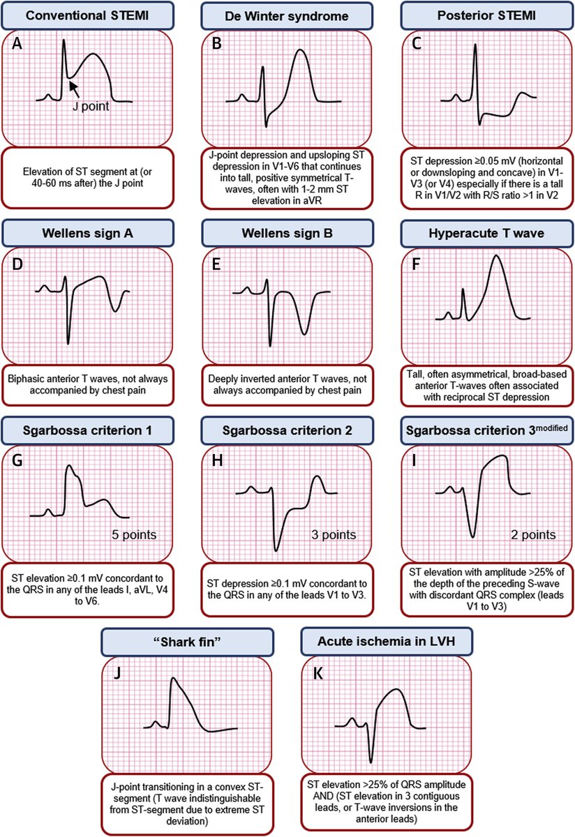 sargsyanz's tweet photo. ECG patterns suggesting coronary occlusion: 

Hadn't seen this nice figure by Asatryan et al. in JACC Case Rep Dec 2019. H/T @RSeervai @bschnett https://t.co/eDzrRo6ABH