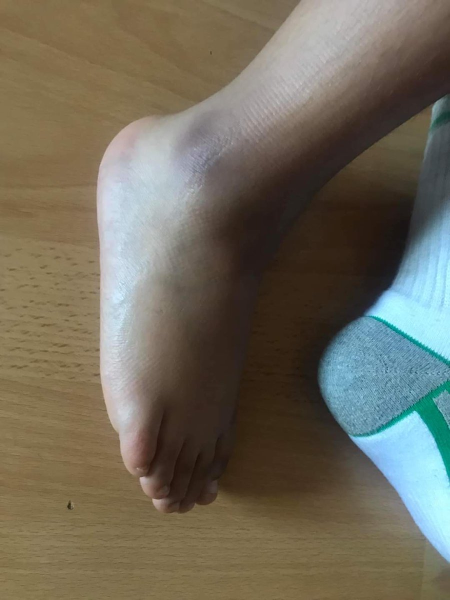 My son did this to his ankle yesterday on a bouncy castle. He's gutted now he cant go to the park and kick a football around for a couple of weeks. He will be back to nutmegging his old man &amp; scoring like <a href="/MarcusRashford/">MR14</a> in no time at all. On the plus side for him more xbox lol
