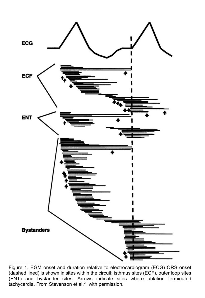 Stevenson et al Circulation 1993 - One of the first descriptions of EGM duration relative to the VT circuit. ⬆️ = VT termination