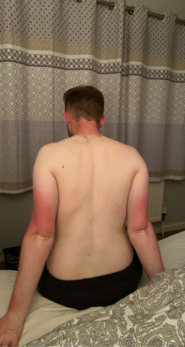 i_amfloyd's tweet photo. You’d think after 23 years of sharing the same skin tone as Casper the friendly ghost I would learn to apply some factor 50 but no https://t.co/6Cfz5Za5ET
