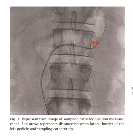 The Arab Journal of Interventional Radiology (@arabjir) on Twitter photo eFirst #AJIR Use of Bony Landmarks during Adrenal Venous Sampling to Guide Catheterization of the Left Adrenal Vein <a href="/LucasRCmd/">Lucas R. Cusumano, MD</a> <a href="/JonnyMoriarty/">John Moriarty</a> <a href="/sipan_MD/">Sipan</a> <a href="/pairsmedia/">PAIRS</a>
Abstract: thieme-connect.com/products/ejour…
Full text HTML: thieme-connect.com/products/ejour…
Full text PDF: thieme-connect.com/products/ejour… eFirst #AJIR Use of Bony Landmarks during Adrenal Venous Sampling to Guide Catheterization of the Left Adrenal Vein <a href="/LucasRCmd/">Lucas R. Cusumano, MD</a> <a href="/JonnyMoriarty/">John Moriarty</a> <a href="/sipan_MD/">Sipan</a> <a href="/pairsmedia/">PAIRS</a>
Abstract: thieme-connect.com/products/ejour…
Full text HTML: thieme-connect.com/products/ejour…
Full text PDF: thieme-connect.com/products/ejour…