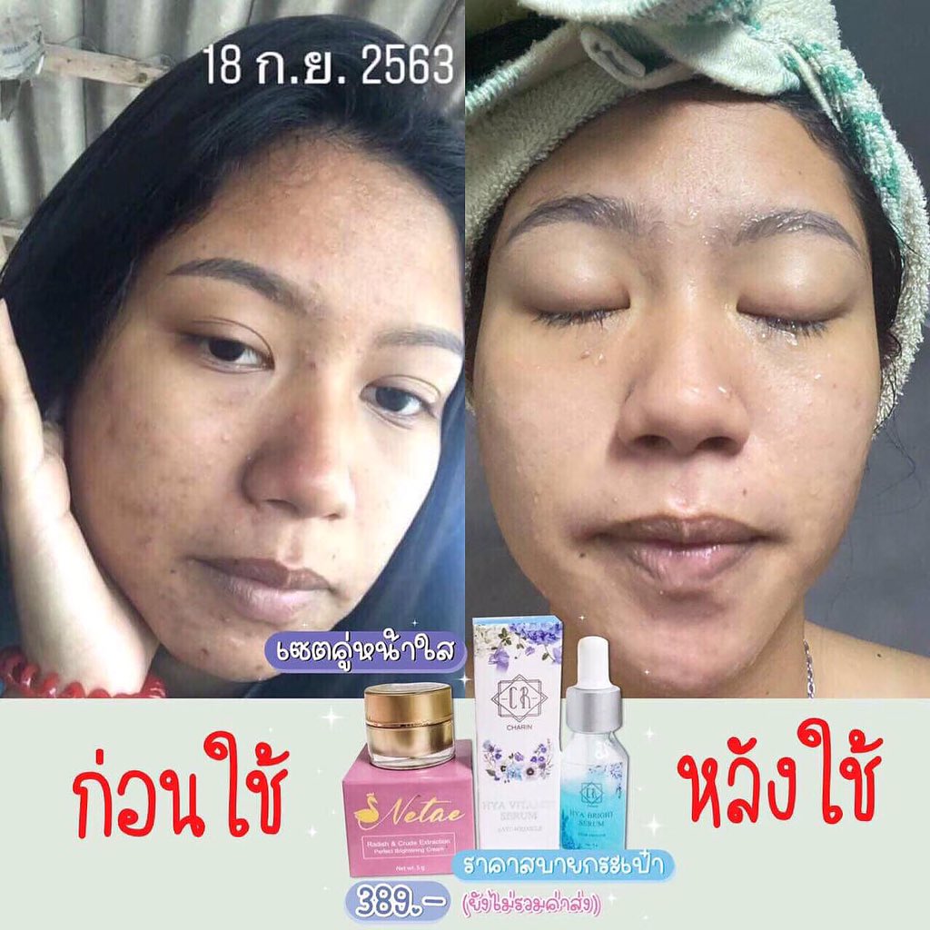 MikellShop's tweet photo. ก่อนหน้านี้คือหน้าพังมาก
หน้าสวย ใส ได้ด้วยเซตคู่ตัวนี้เลย 😱😊

#เนเต้ไนท์ครีม #เซรั่มไฮยา 💜

#ครีมหน้าใส #รักษาสิว #ครีมรักษาสิว #ฉันจะสวย #หน้าใสไร้สิว #ถูกและดีบอกต่อ #ครีมหน้าขาว #ครีมลดสิว #ครีมบำรุงผิวหน้า #howtoperfect #ดีบอกต่อ #ครีมบำรุงหน้า #ฉันจะขาวฉันจะสวย 
#ครีม https://t.co/qgkk7MYHPP