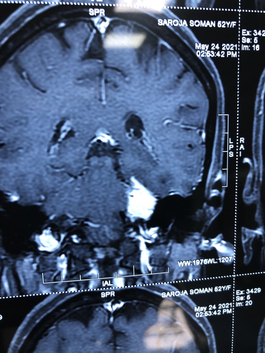 drsayujkrishnan's tweet photo. 51 year old lady with severe facial pain. MRI brain showed left petrous lesion. She underwent a standard retrosigmoid approach and excision of lesion and recovered completely from facial pain. #brain tumour #endoscopic brain surgery #meningioma https://t.co/xS6SQ4W7m5