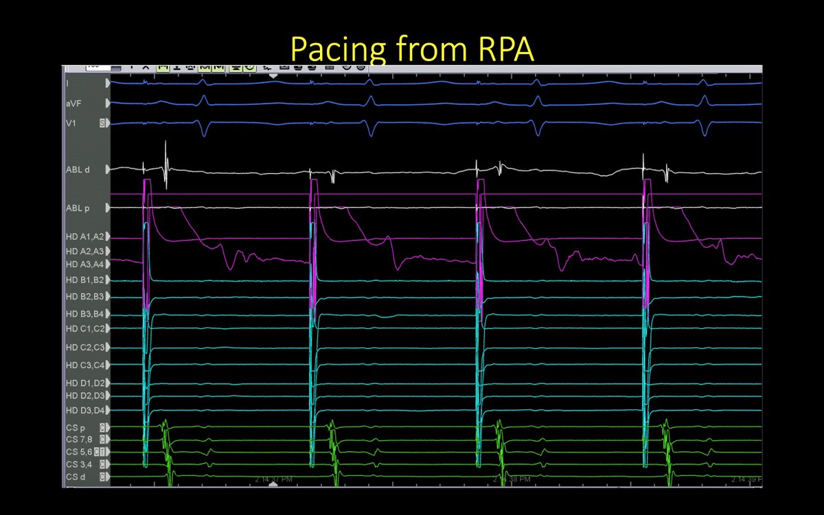 I wonder if ablation here (is safe and) would work for a refractory roof line/flutter @AbbottCardio @maddyferraro1