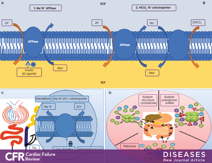 RC_HeartFailure's tweet photo. Hyperkalaemia poses a major challenge in the management of #heartfailure patients, presenting in 16% to 25% of cases. 
 
Here, Ismail et al. discuss pathophysiology and management of hyperkalaemia in #HF 👉 https://t.co/eq9RHBYYW5 @ShelleyZieroth #CFRJournal #CardioEd #Heart https://t.co/fEUX92vlxc