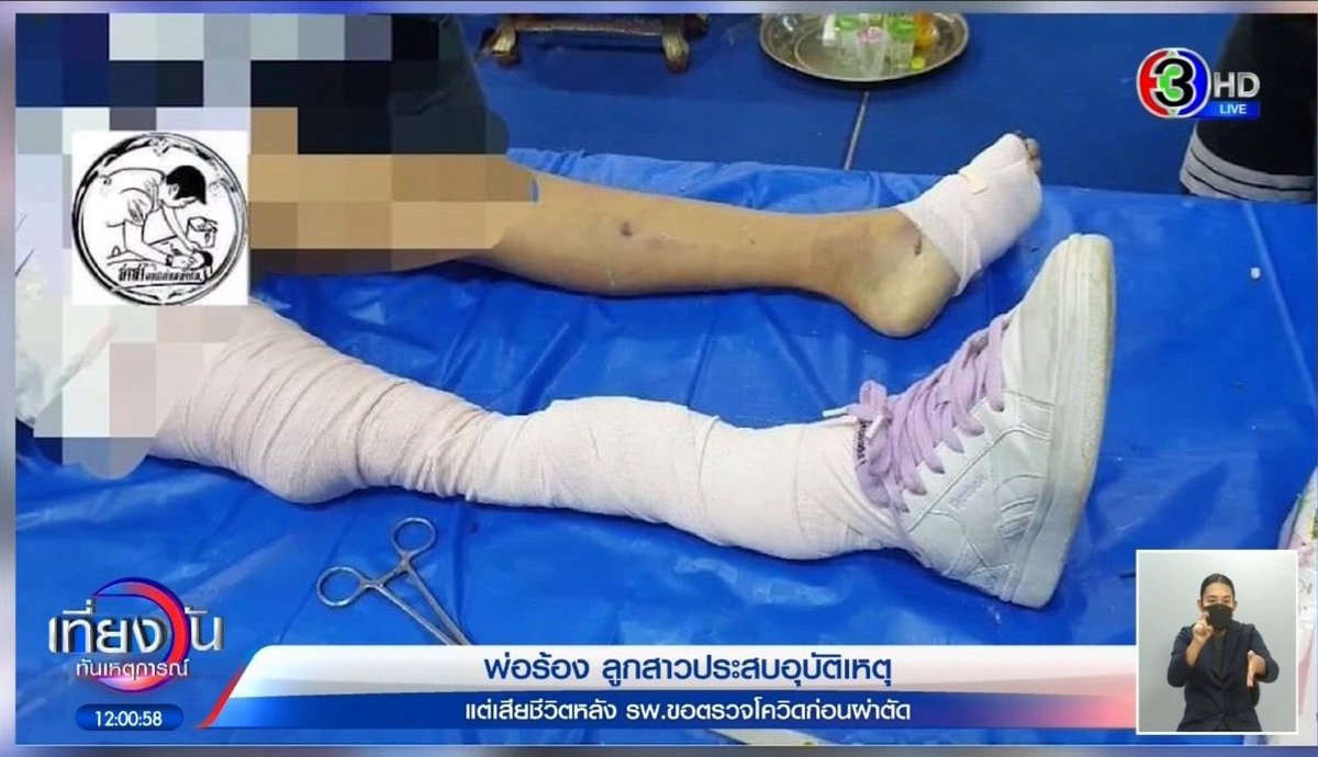 _mybliss's tweet photo. ไทยแลนด์แดนดัดจริต 🙄 น้องประสบอุบัติเหตุขาขาด ทางโรงพยาบาลบอกว่าไม่เร่งด่วน คือเอาตรรกะอะไรมาคิด นาทีนั้นต้องช่วยก่อนไหม! ใส่ชุด PPE รักษาเหมือนน้องเป็นผู้ป่วยโควิดไปเลยระหว่างรอผลโควิด บางทีอาจจะรักษาชีวิตน้องไว้ได้ ไม่ใช่ปล่อยไว้จนน้องเสียชีวิต
#เที่ยงวันทันเหตุการณ์
#โหนกระแส https://t.co/83nBToxfrd