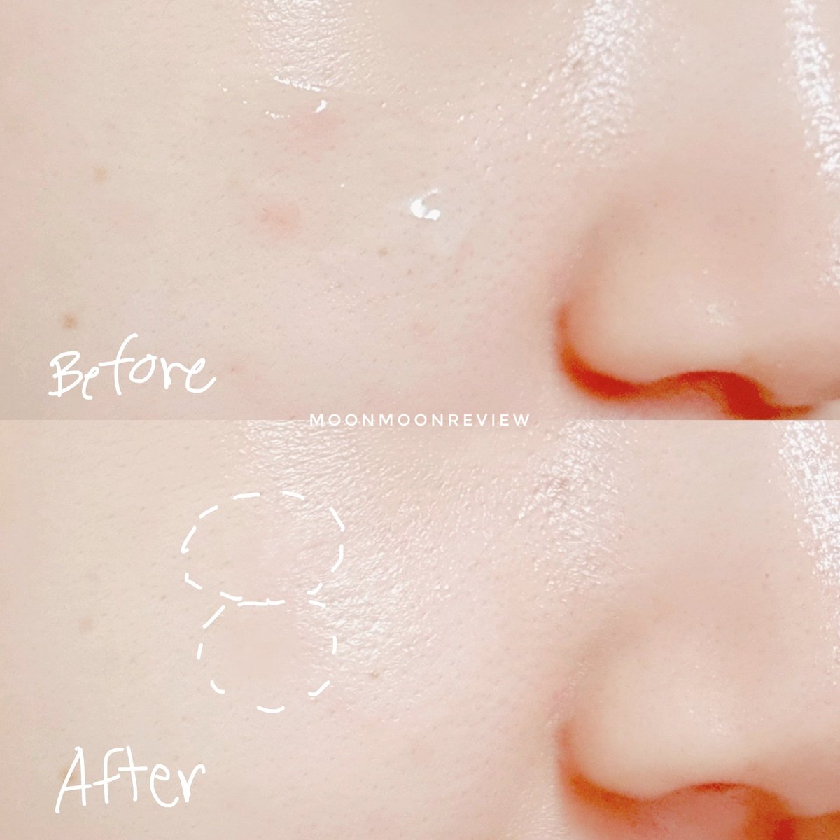 moonmoonreview's tweet image. อภินิหารครีมซองอีกแล้ววว The Original Premium CICA Acne Serum Gel 🍀 ทาไปเลยตั้งแต่สิวเริ่มเป่ง ทุกวันๆ นี่ลองไม่บีบสิวใดๆ สรุปยุบจริง แถมที่ชอบมากๆคือรอยสิว แทบหายไปพร้อมกับสิวเลย จางลงไวม้ากก อันนี้เราซื้อมาจากเซเว่น 49฿ น้า #เซรั่มสิว #เจลแต้มสิว #ใช้ดีบอกต่อ #รีวิวเซ่เวน