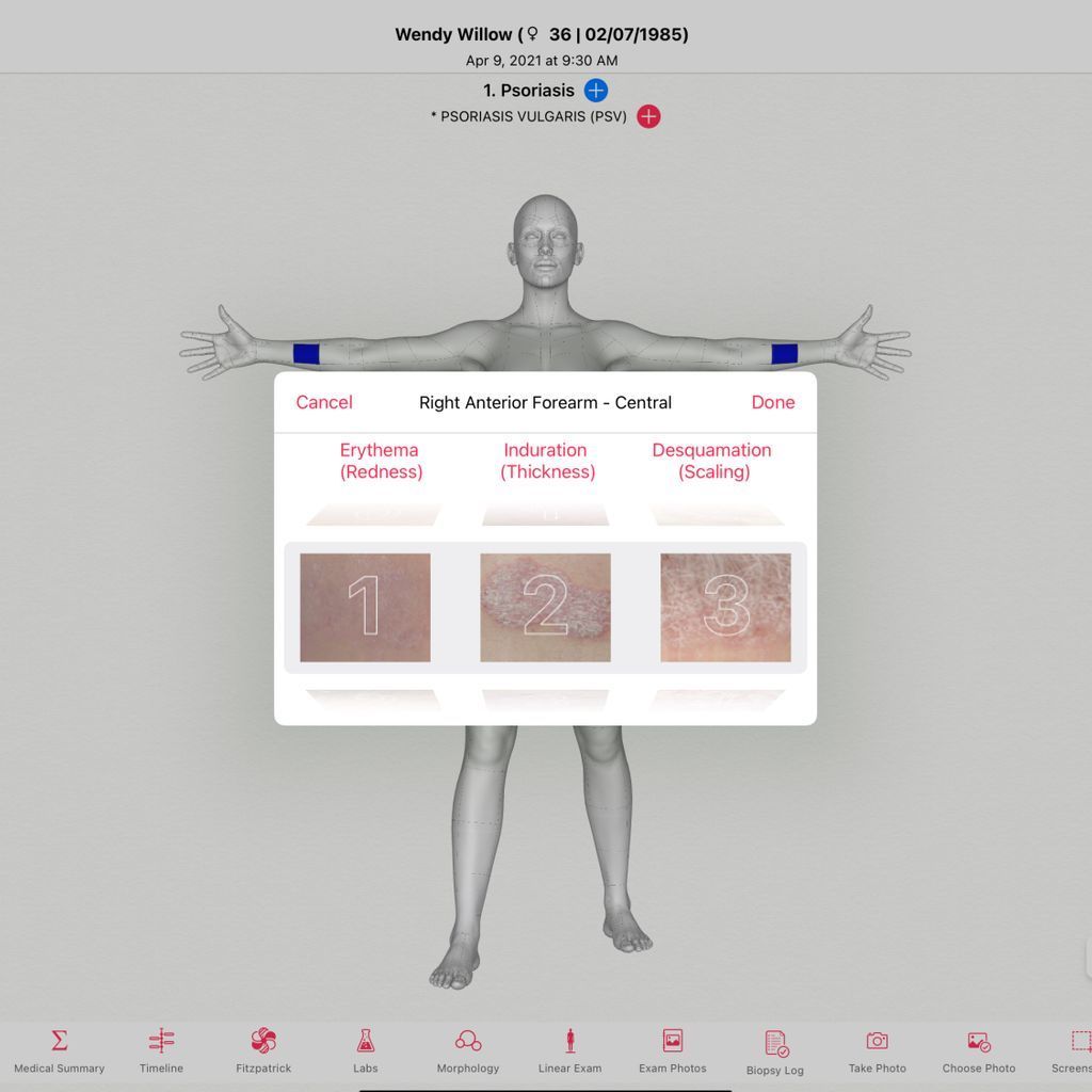 EZDERM's tweet photo. EZDERM comes with a built-in Psoriasis Area Severity Index (PASI) Calculator. #psoraisis #ehr #emr https://t.co/ARX5uBc5DU