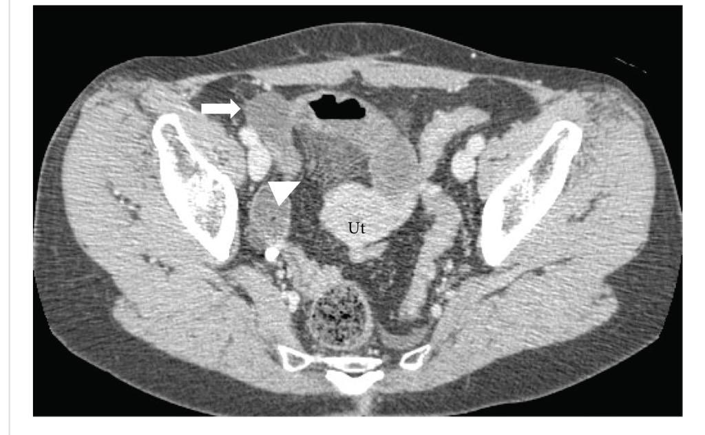 10bladeae's tweet photo. It’s #FIOF time! What’s the cause of obstruction in this patient with the following CT 🧐 #FigureItOut through the link in the bio! 
#10blade #SoMe4Surgery #SurgicalResident #Dubai 
#UAE #generalsurgery #imagechallenge https://t.co/JtUqBDGNhg