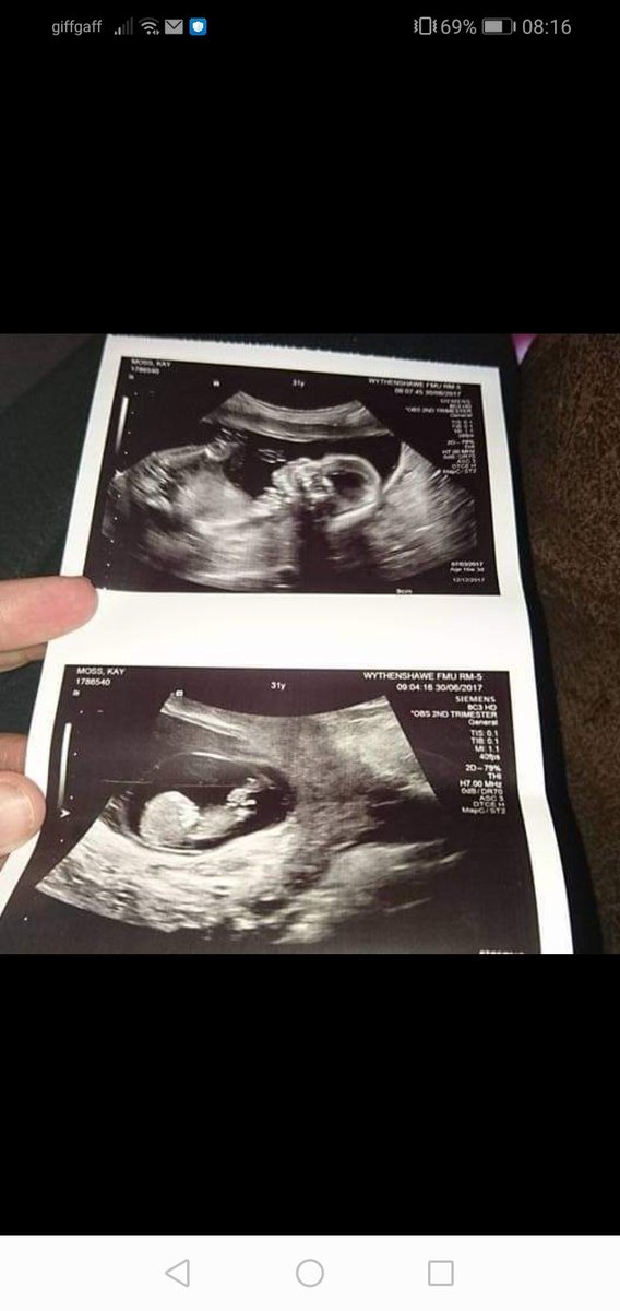 tonyoo71's tweet photo. Today is my daughters day Likkle PeaPod she sadly went to sleep cuddling her twin brother in mummys belly, shes always with us though through heart and mind e tra cuddles for her brother today thank you to everyone whos stood by me and git us where we are today 💐⚽🦋🐝#30peapod https://t.co/YSGlorlcTK