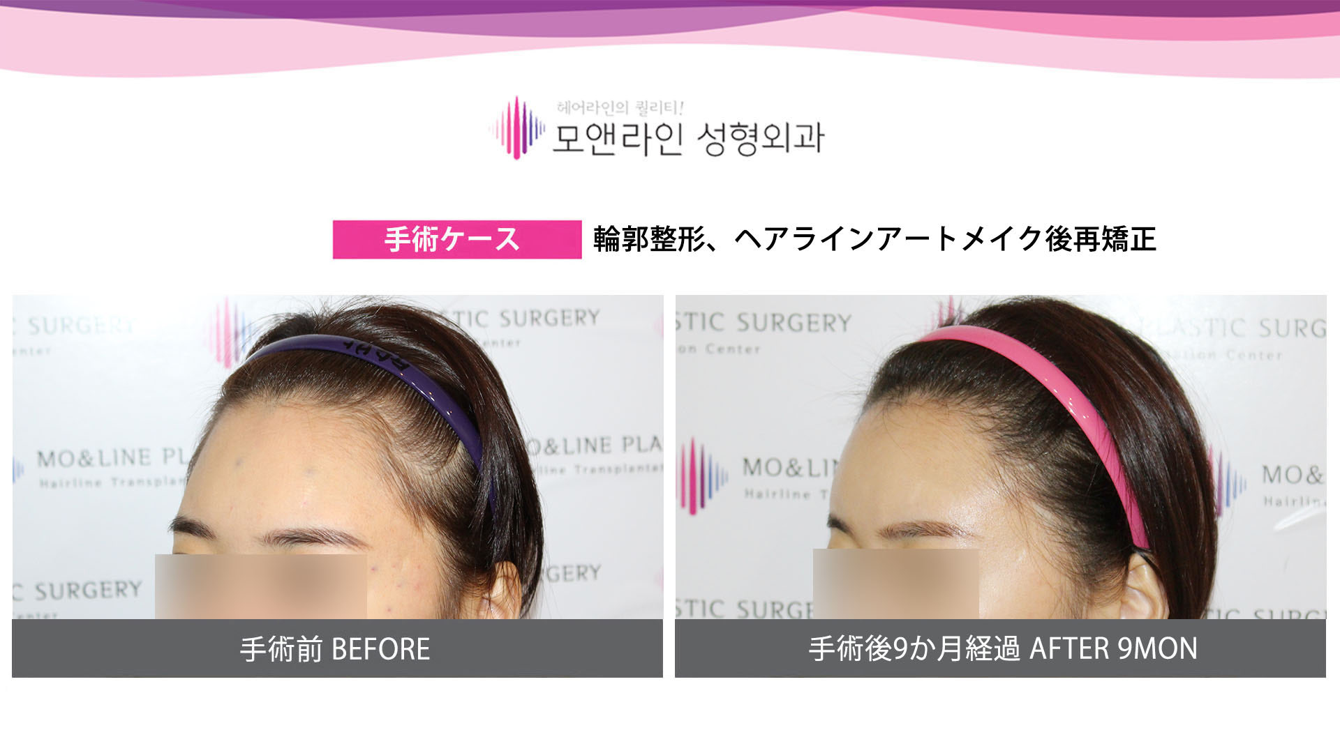 モ ヘアーライン美容整形外科 ヘアラインが綺麗に整うだけでも美人度がグッとupします 半永久のアートメイクよりも自然で一生続く毛髪移植ヘアライン矯正をおすすめします ヘアライン矯正 生え際矯正 毛髪移植 額縮小 自毛植毛 薄毛