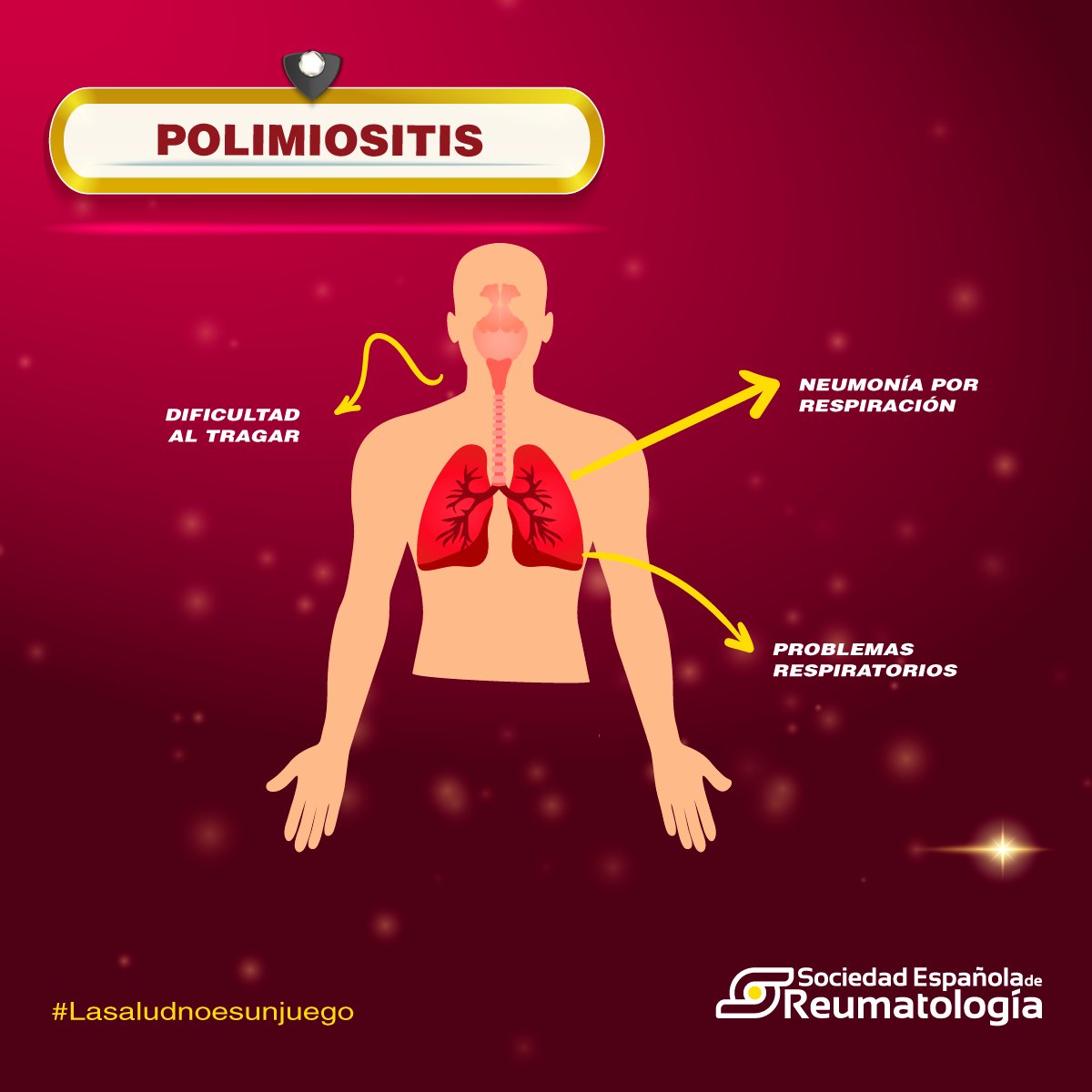 SEReumatologia's tweet photo. La polimiosotis es una enfermedad inflamatoria poco frecuente que causa debilidad muscular extrema. Las enfermedades reumáticas autoinmunes, no son un juego ¡Acude al reumatólogo! #LaSaludNoEsUnJuego https://t.co/lyqKZ5ssh3 https://t.co/9vvBFfXjIK