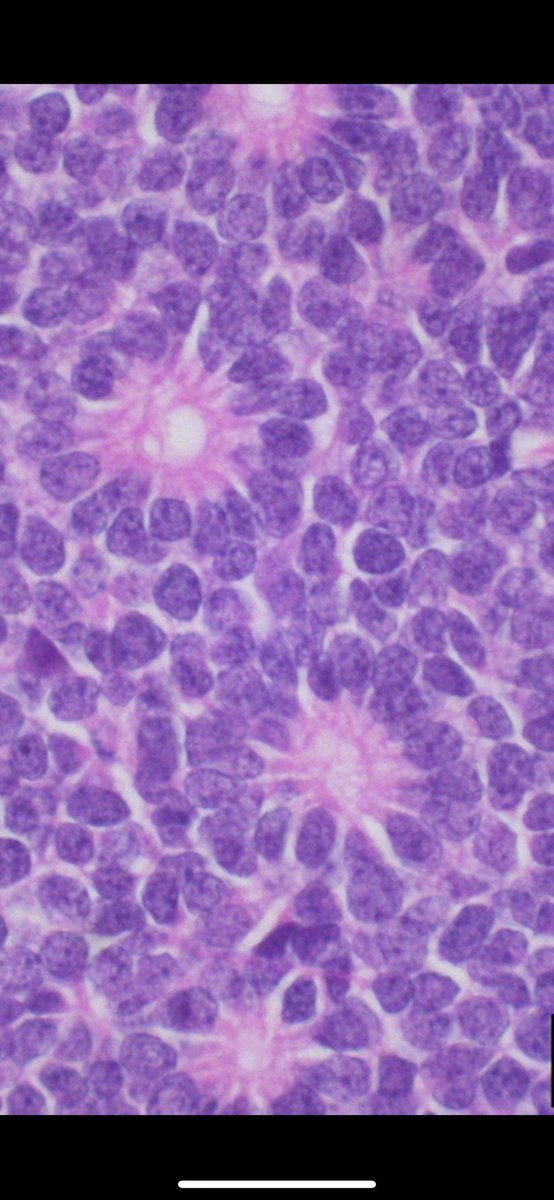 Eye tumor from a baby. Entire globe of eye cut in half front to back. Amazing pics by Dr. Monica Evans. Your diagnosis? Reply then click the link to check your answer kikoxp.com/posts/4321 #pathologists #pathology #pathTwitter #ophthalmology #ophtho #eyepath