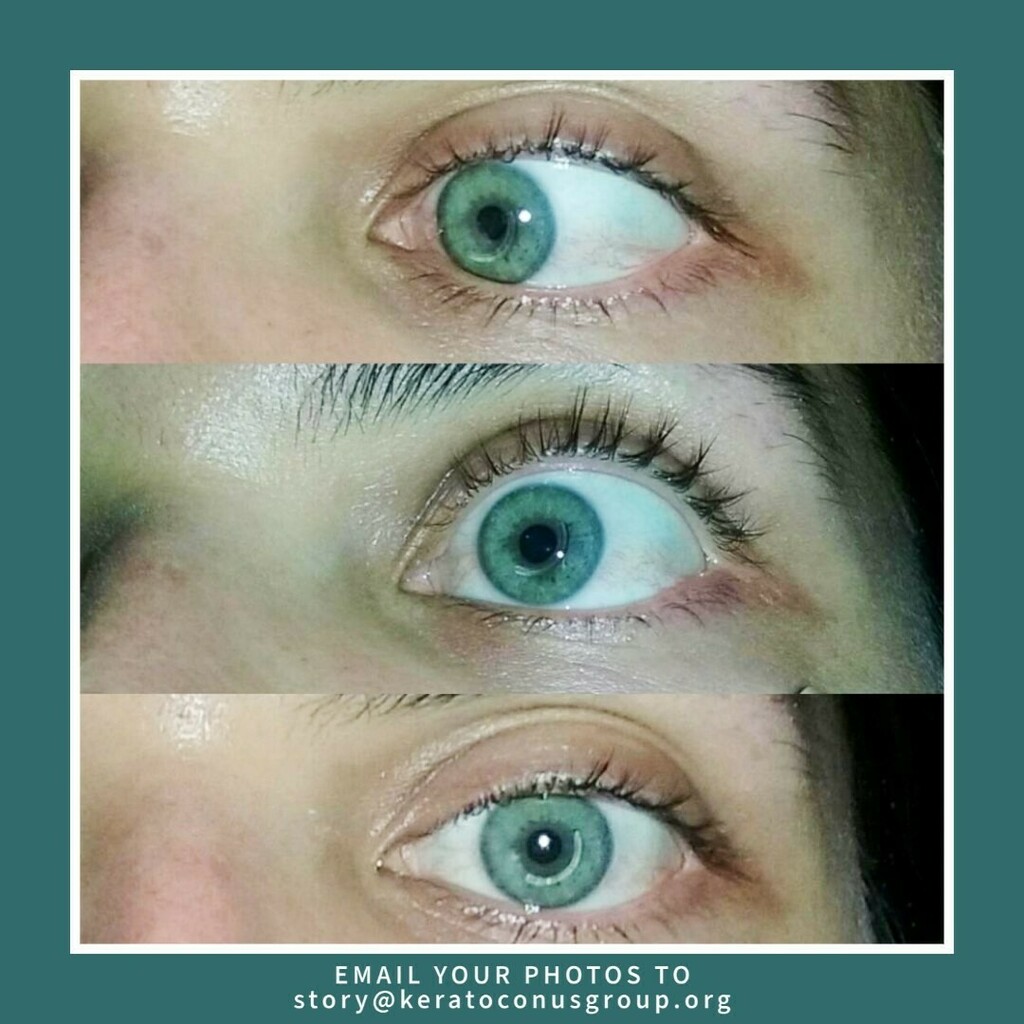KeratoconusGRP's tweet photo. #Intacs #corneal implants are an ophthalmic #medical device designed for the reduction or elimination of #myopia and #astigmatism in patients with keratoconus so that their functional #vision may be restored and the need for a #cornealtransplant procedur… https://t.co/paFYsIL26Q https://t.co/vqa8TMteI3