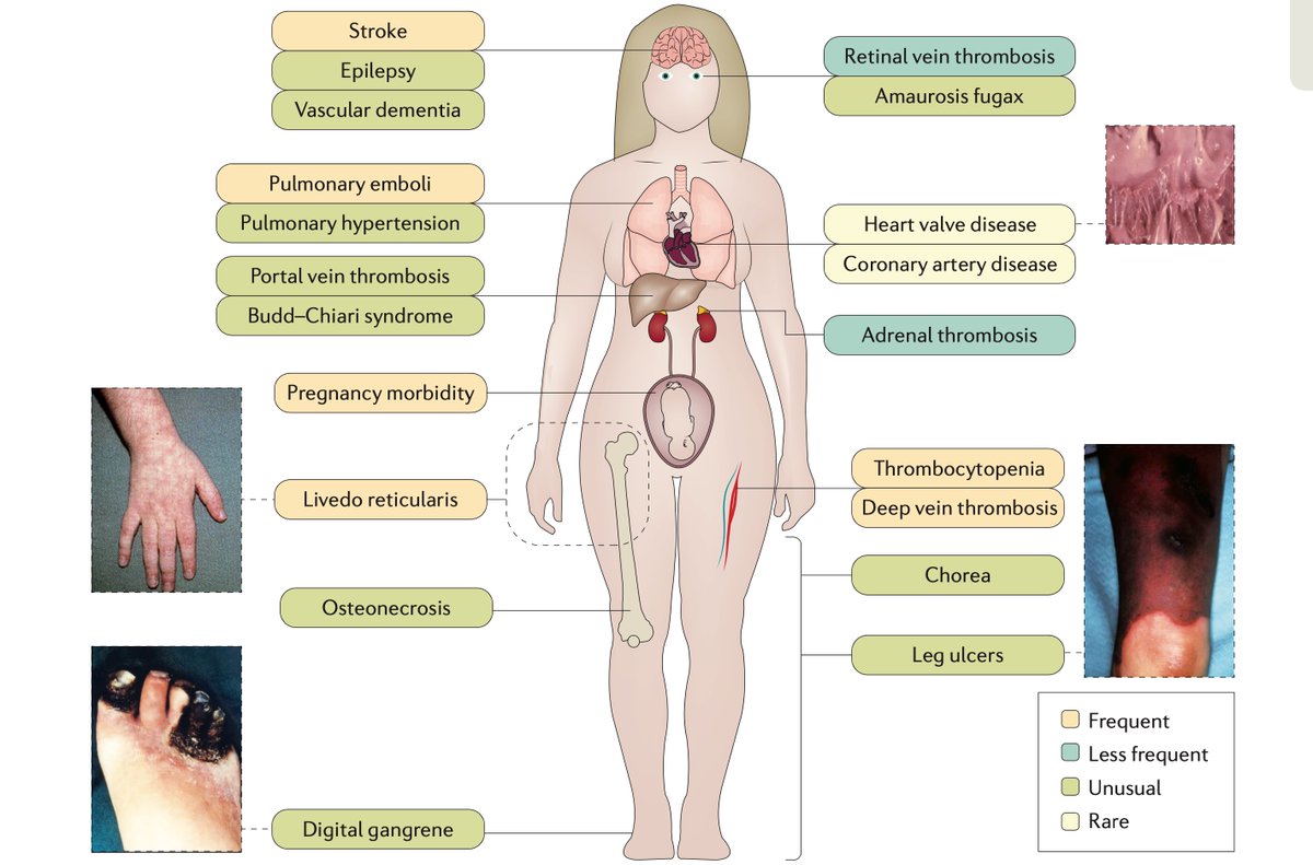 drkeithsiau's tweet photo. Antiphospholipid syndrome: clinical features and diagnostic criteria #MedEd

https://t.co/8tsHNIUY3S https://t.co/SxZ5OF0Zqt