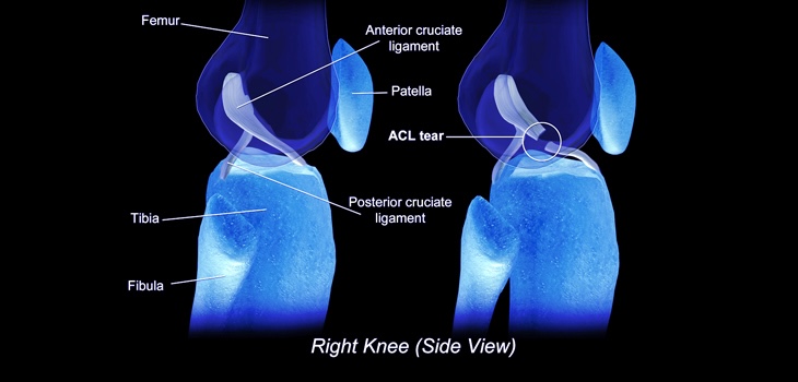 1/3 of patients undergoing ACL surgery before 20 y/o will unfortunately reinjure the ACL: ryortho.com/breaking/1-in-…