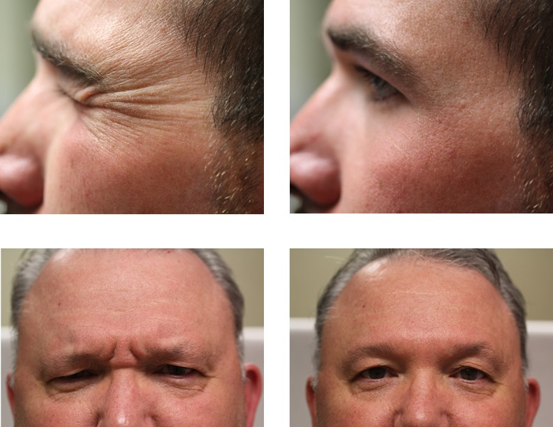 vitality_for's tweet photo. Men have concerns, too.  Crow's feet lines and glabellar lines (between the eyebrows) are the highest priority treatment area for men.  Call us today about our Botox specials. https://t.co/j92qc1UGNo