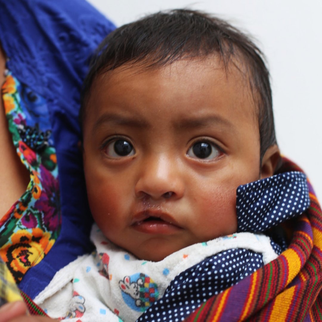 Smiletrain's tweet photo. Meet Smile Train patient Marlon from Guatemala 💙

Every day, 540 babies around the world are born with a cleft. Smile Train is committed to working tirelessly until every child with a cleft has access to safe, quality cleft treatment.

Learn more: https://t.co/I8FQi10D4p https://t.co/yG0ewTkGYI