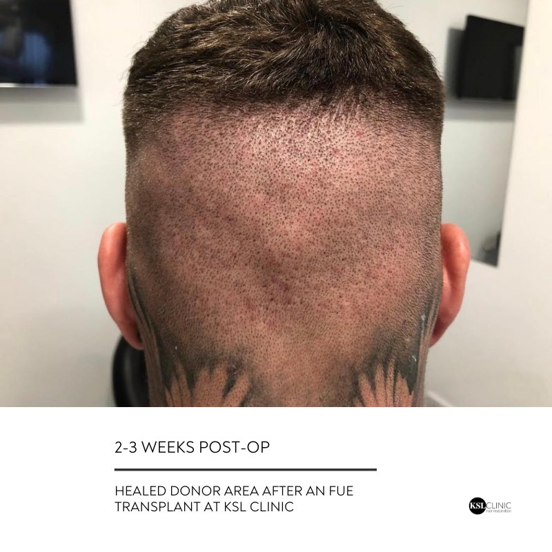 KSL Clinics | Hair Transplant Experts on Twitter: KSL Clinics | Hair Transplant Experts on Twitter: