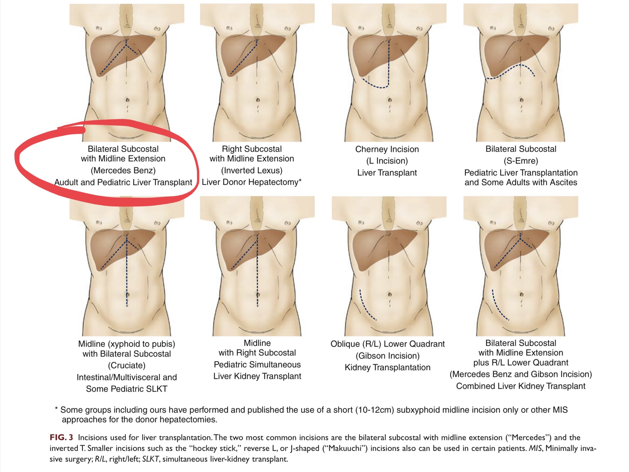 Liver Transplant Incision