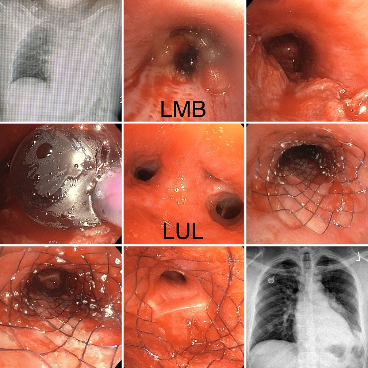 Behind door number one... Complete left lung collapse due to obstruction of LMB with metastatic edobronchial tumor. Recannulated with rigid forceps, cryo-resection, and endobronchial fully covered stent with full re-expansion of LUL. With <a href="/pulmo_dok/">Napoleon Puente</a>