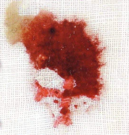 The Eucharist miracle of Sokolka in Poland is very well known. On October 12, 2008, a Eucharist Host turned into flesh at a Catholic church in the city. Scientific analysis has proved that the host is cardiac tissue from the heart of a dying man.