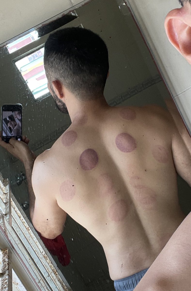 ReyMicho's tweet photo. 🥺odio y amo a las ventosas 🥺 https://t.co/vOBGkGNYQx