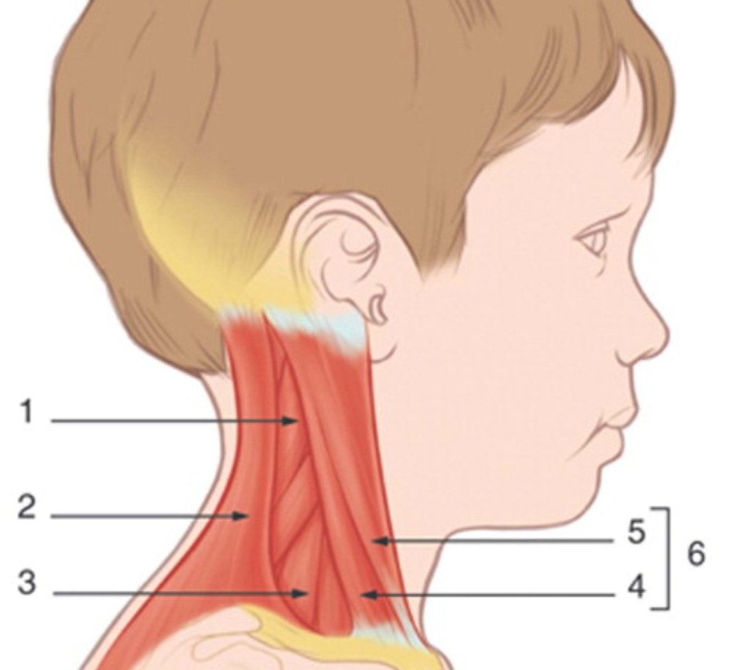 SaidDLCR's tweet photo. El uso del músculo esternocleidomastoideo es el único que se ha visto que su manifestacion/uso refleja afección de vías respiratorias bajas - Dr Mario Acosta Bastidas #UpdateSMME #CrisisAsmatica https://t.co/OBmHFh33Vp