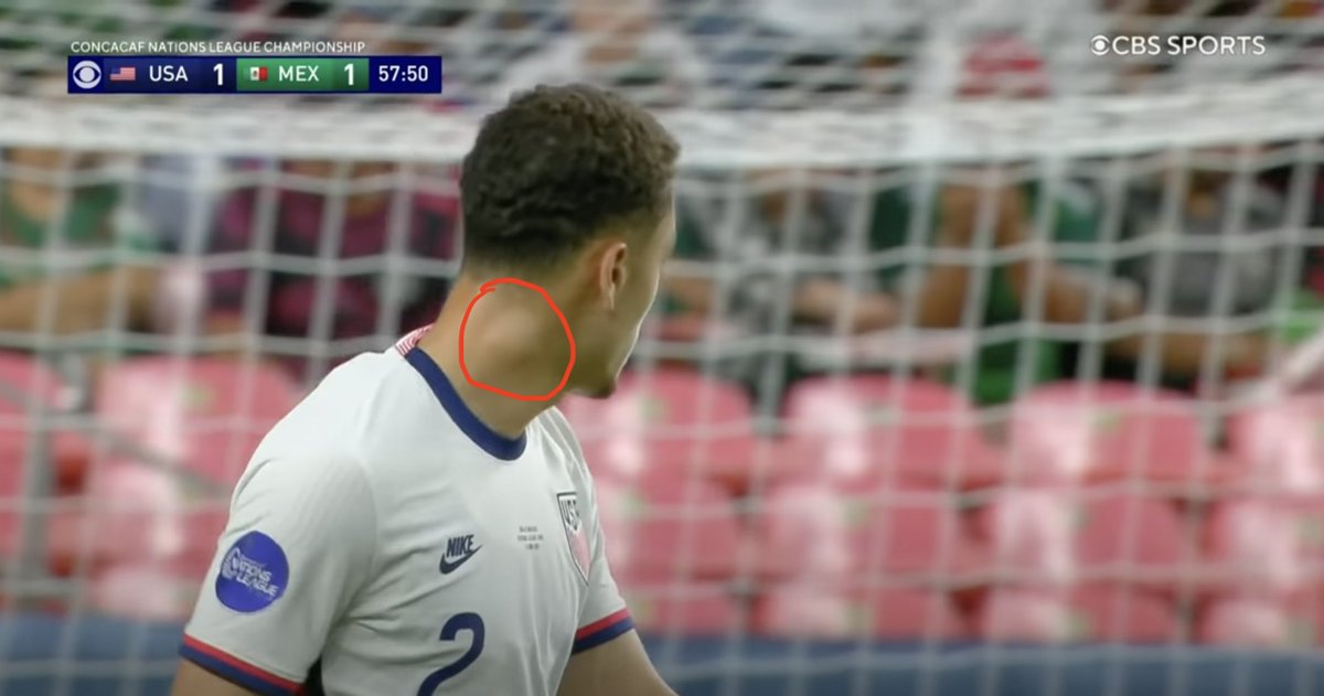 bobmullaney's tweet photo. Is this lump on @sergino_dest 's neck something to be concerned about? @USMNT, this could be something to look into - even if it's out of an abundance of caution. https://t.co/WfCulR71Im