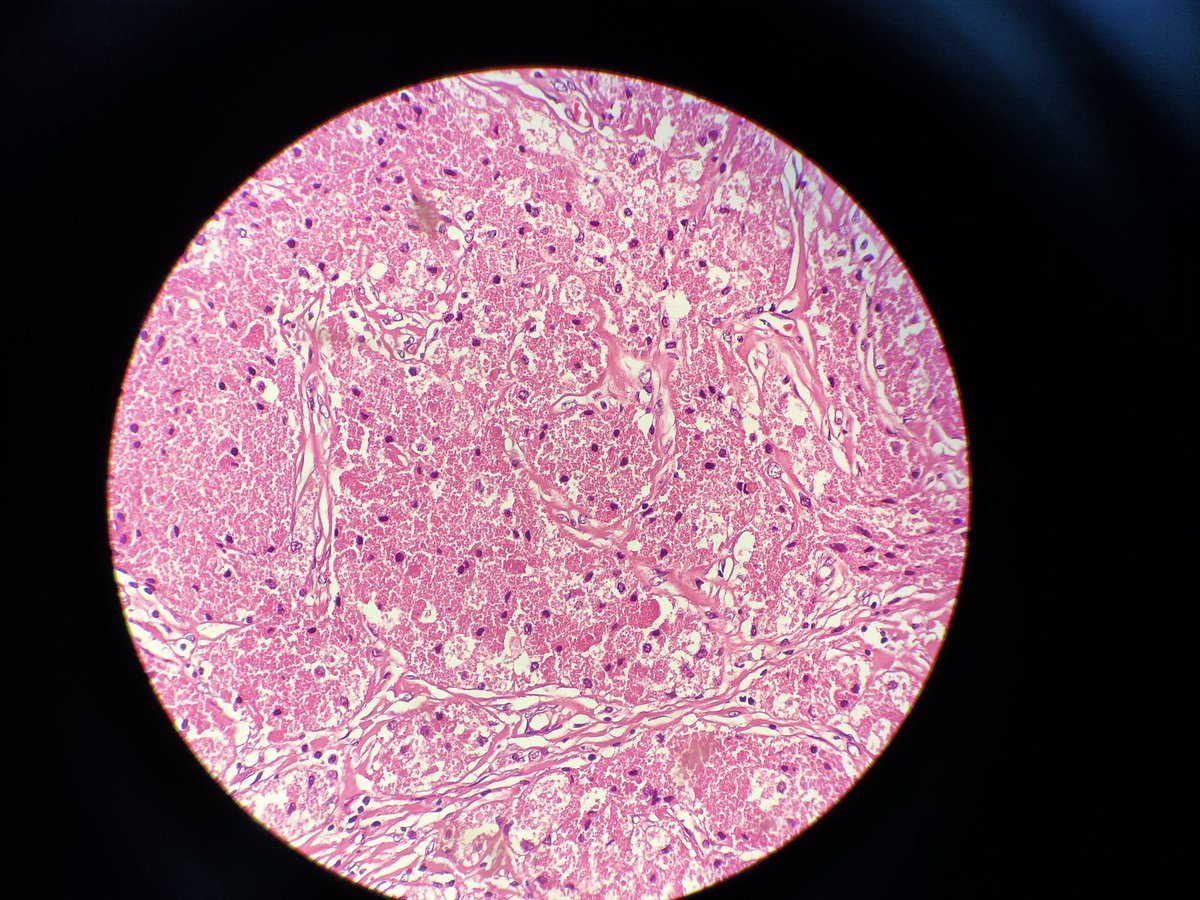 Andy_pathology's tweet photo. Breast tumor, what is your diagnosis? I will release the answer the next day. https://t.co/VNdgvMSNce
