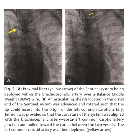 eFirst #AJIR Prevention of Paradoxical Cerebral Embolus with Protection System during Combination Right Atrial Clot Aspiration Thrombectomy and Closure of Patent Foramen Ovale Abstract: thieme-connect.com/products/ejour… Full HTML: thieme-connect.com/products/ejour… Full PDF: thieme-connect.com/products/ejour…
