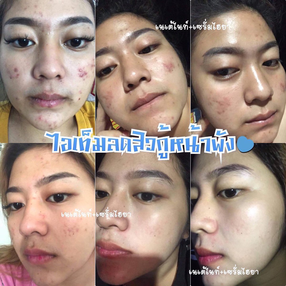 MikellShop's tweet photo. 💢ต้องใช้คู่กันนะตัวเอง💢
❤️เซรั่มไฮยา&amp;เนเต้ไนท์ครีม❤️ขนาด 5 g
ทาก่อนนอนช่วยให้หน้าดีขึ้นอย่างเห็นได้ชัด ช่วยเรื่องปัญหาฝ้า,กระ รอยดำ รอนแผล จางหายไวเวอร์ #คู่นี้ราคา3⃣8⃣9⃣บาท

#ครีมรักษาสิว #ฉันจะสวย #หน้าใสไร้สิว #ถูกและดีบอกต่อ #ครีมบำรุงผิวหน้า #howtoperfect #ดีบอกต่อ #ครีม https://t.co/8QWbFgycB0