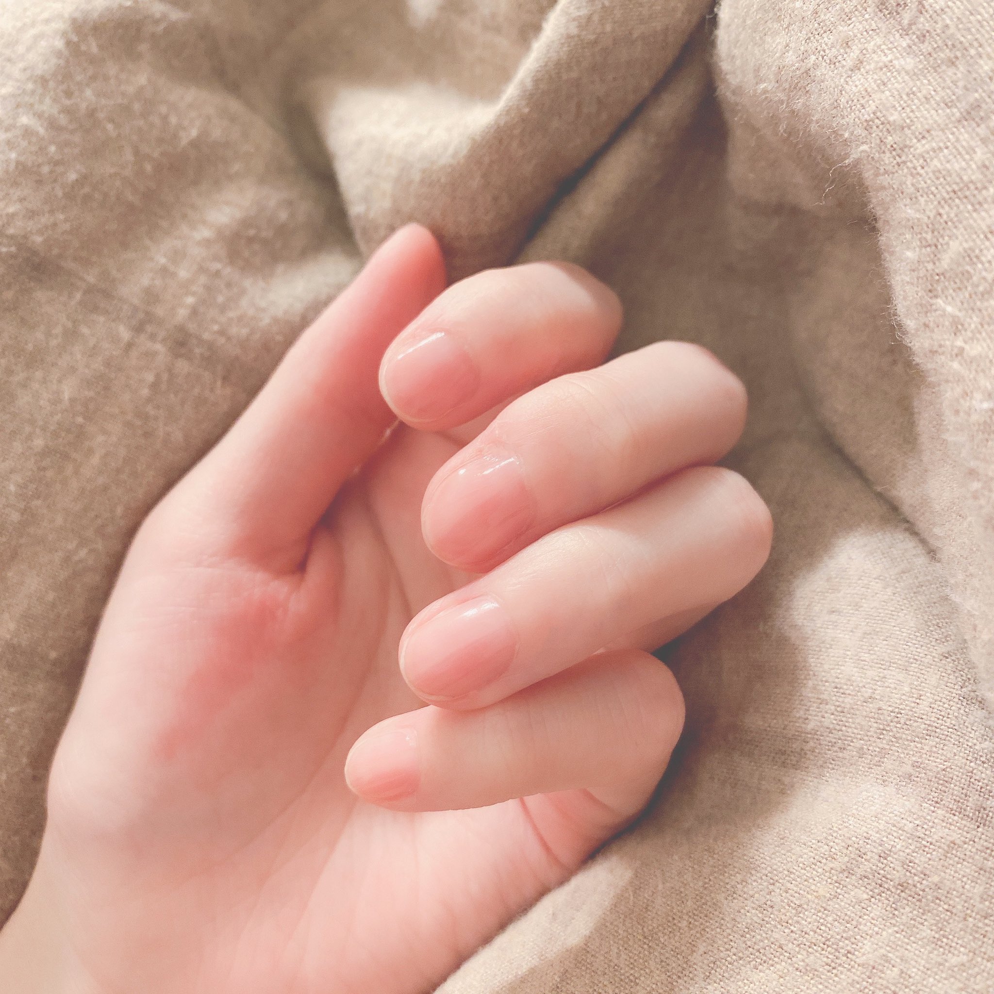 出血して 炎症を起こしてもやめられず 有村藍里が明かした 皮膚むしり症 Twitter