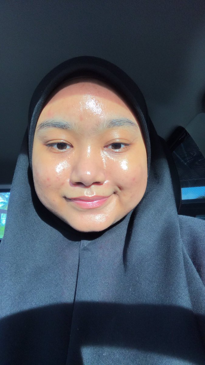 ijahhhh_'s tweet photo. Sunkissed 😘 in love with my current skin 🥰
#acnefighter
#acneisnormal
#skintextureisnormal
#ytjt https://t.co/cGhEE20Suy