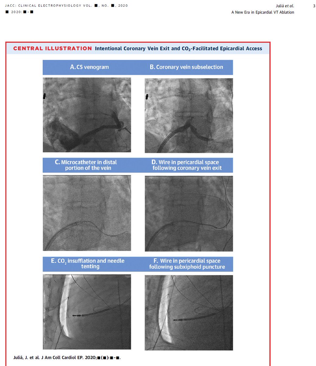 New Era of CO2 to facilitate Epicardial Access for the Ablation of Ventricular Arrhythmias? The Epi-Co2 Registry. from Juliá et al, #jaccep #epeeps