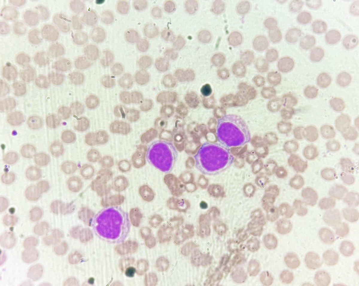 NidhinMd's tweet image. 26 year old male with fever and generalised weakness for 05 days presents with a total leukocyte count of 88,500. He is supposed to get married next week! #PathTwitter #twitterpath #pathresident #pathology #hematology #hematopat #hemepath #diagnosis #leukemia