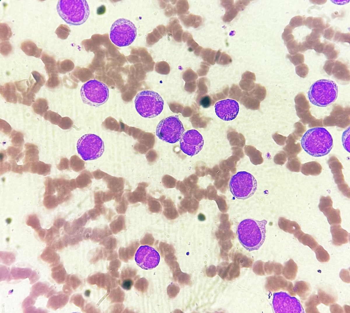 NidhinMd's tweet image. 26 year old male with fever and generalised weakness for 05 days presents with a total leukocyte count of 88,500. He is supposed to get married next week! #PathTwitter #twitterpath #pathresident #pathology #hematology #hematopat #hemepath #diagnosis #leukemia