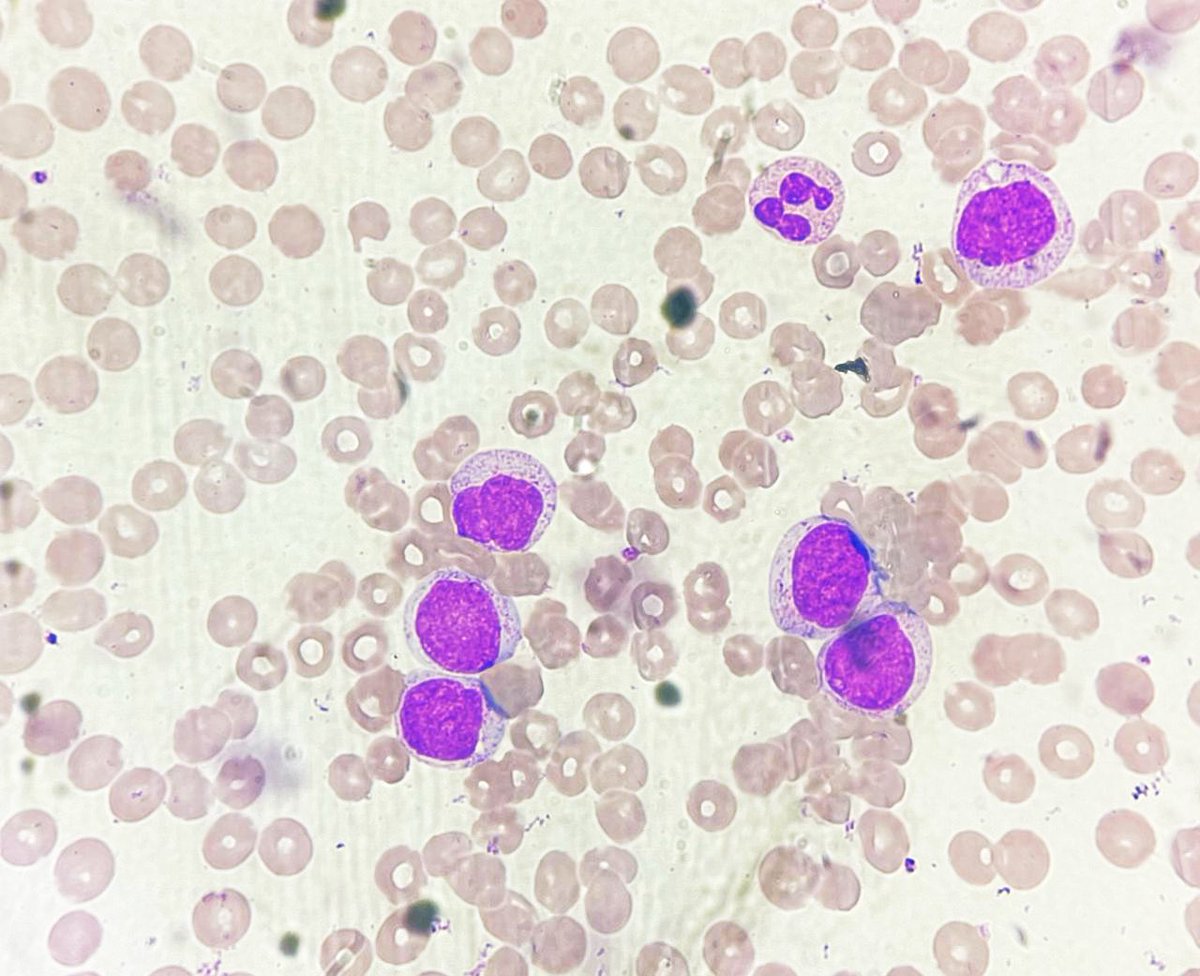 NidhinMd's tweet image. 26 year old male with fever and generalised weakness for 05 days presents with a total leukocyte count of 88,500. He is supposed to get married next week! #PathTwitter #twitterpath #pathresident #pathology #hematology #hematopat #hemepath #diagnosis #leukemia