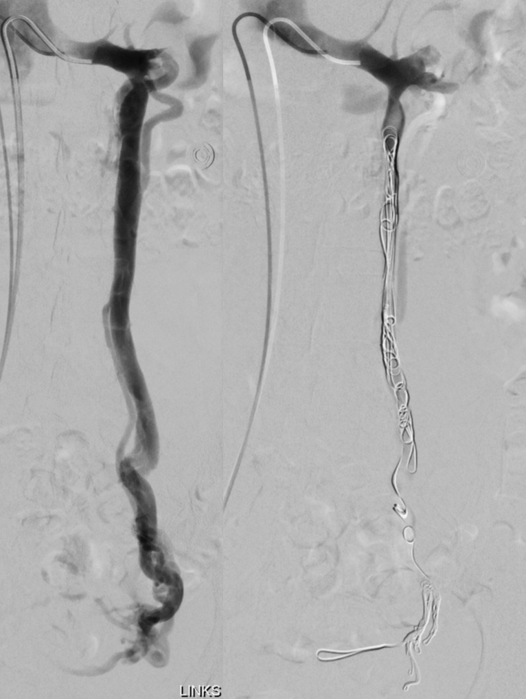 CIRSE (@cirsesociety) on Twitter photo #CIRSEtakeover 32 y/o female patient with pelvic congestion syndrome (PCS). Successful occlusion of left ovarian vein using foam and detachable microcoils. #PCS - for women often a long way to the right diagnosis - followed by a relatively quick #IR procedure. #ET2021 #CIRSE2021 #CIRSEtakeover 32 y/o female patient with pelvic congestion syndrome (PCS). Successful occlusion of left ovarian vein using foam and detachable microcoils. #PCS - for women often a long way to the right diagnosis - followed by a relatively quick #IR procedure. #ET2021 #CIRSE2021